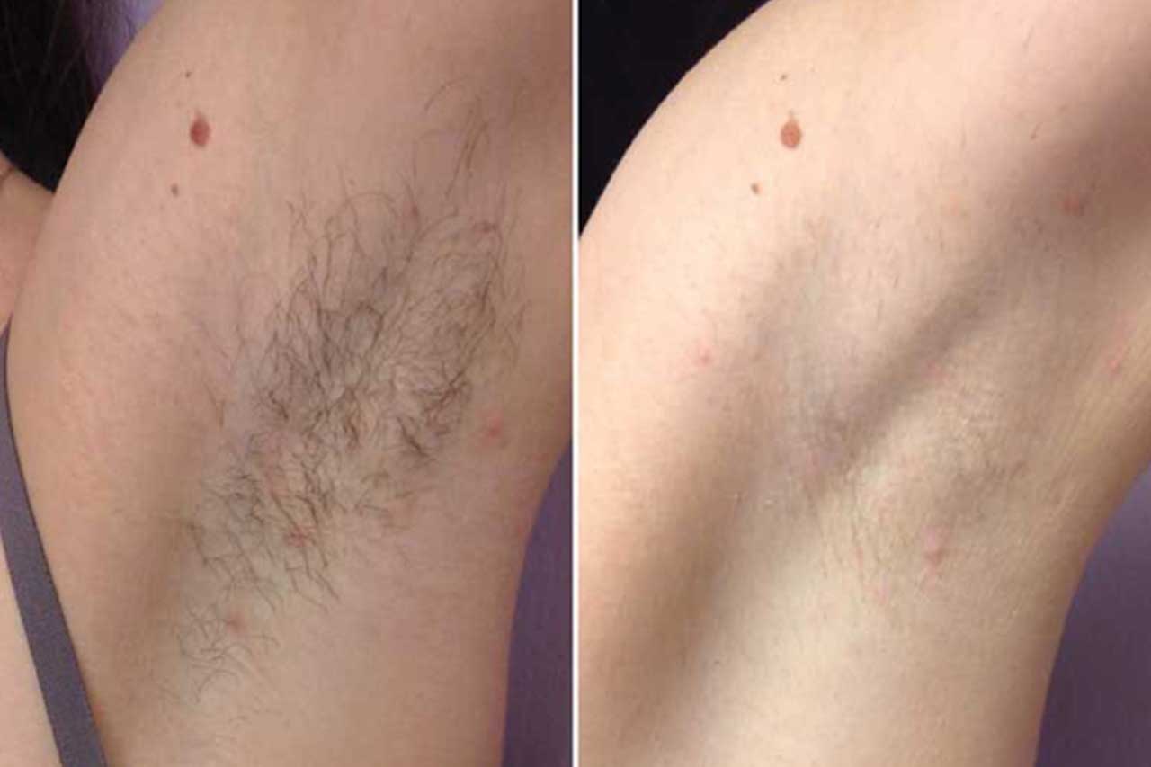 Laser hair removal before and after facial results