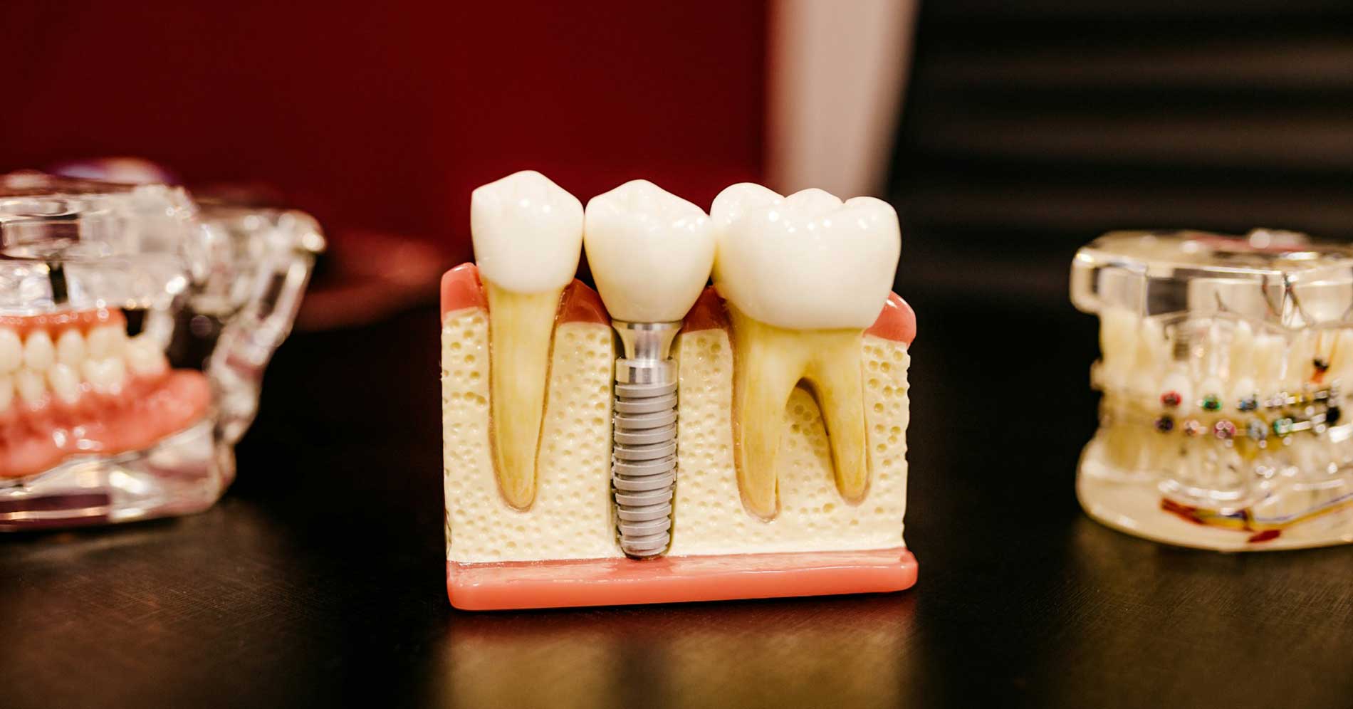 Dental filling procedure
